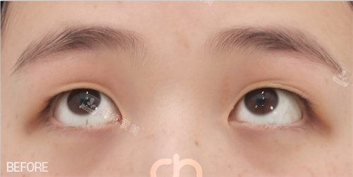 雙眼皮術(shù)前照片 雙眼皮術(shù)前照片