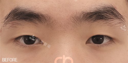 雙眼皮術前照片 雙眼皮術前照片