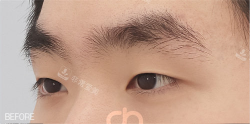 雙眼皮術前照片 雙眼皮術前照片