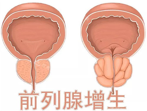 前列腺增生形象图