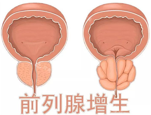 前列腺增生形象圖