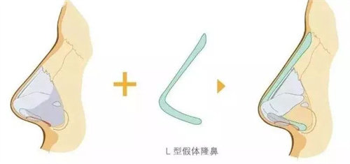 L型假体动画展示图 L型假体动画展示图
