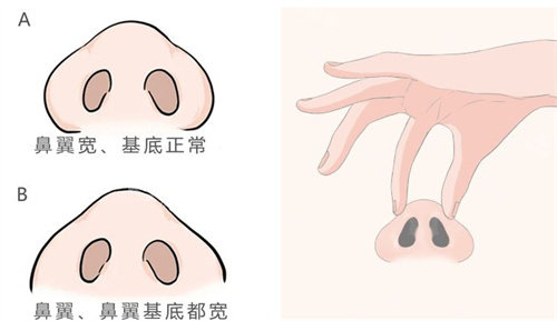 鼻翼缩小展示图 鼻翼缩小展示图