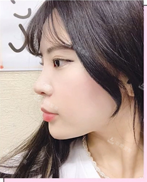 術(shù)后三個月 術(shù)后三個月