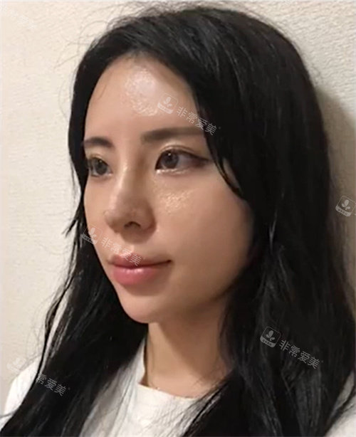 手術(shù)后第七天 手術(shù)后第七天