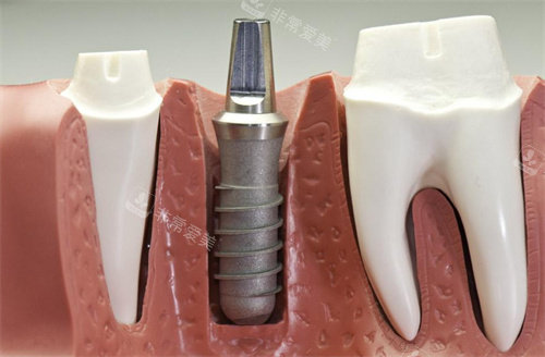 种植牙模型图