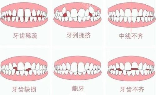 各种牙齿畸形示意图