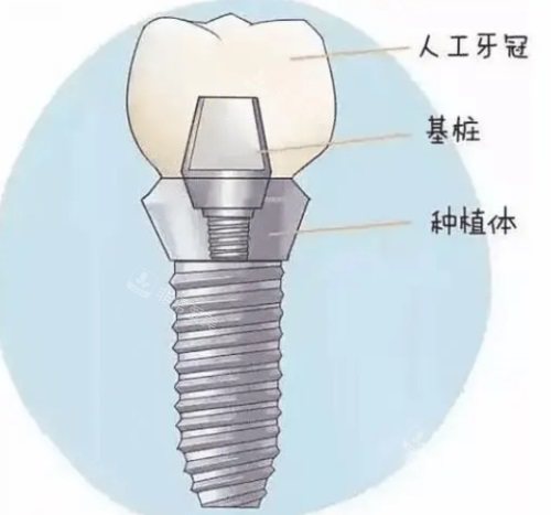 種植牙組成示意圖