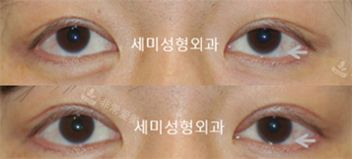 韩国世美整形外科眼矫正实例图
