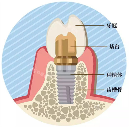 种植牙示意图