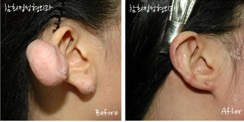 Dr.hams整形疤痕疙瘩修復前后照片 Dr.hams整形疤痕疙瘩修復前后照片