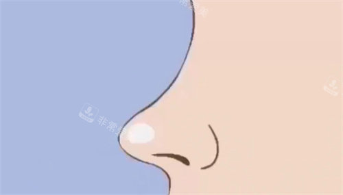 隆鼻术后动画图