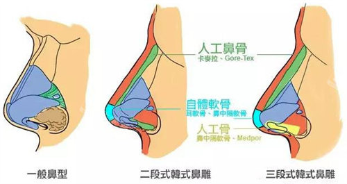 鼻型圖