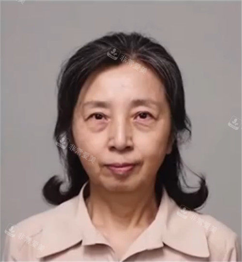 拉皮手術(shù)術(shù)前照片