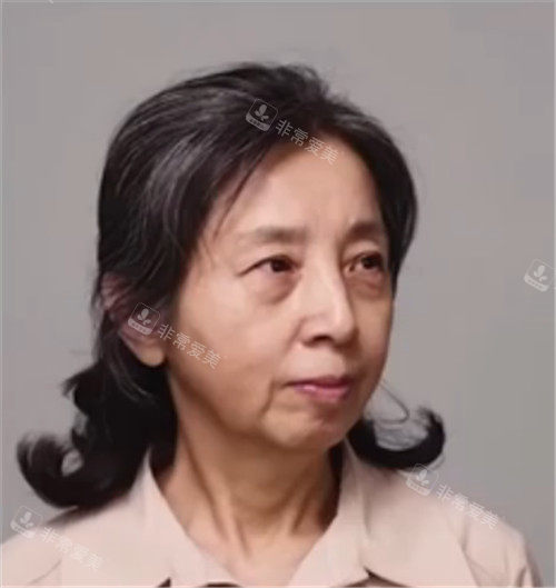 拉皮手術(shù)術(shù)前側(cè)面照