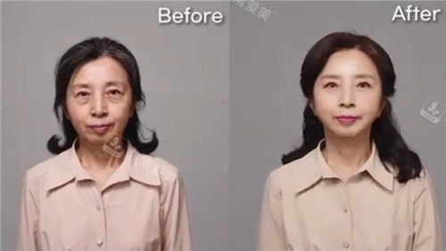 優(yōu)雅人整形拉皮手術(shù)前后圖片