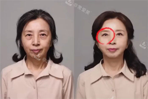 拉皮手術(shù)前后變化圖