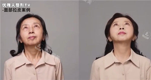 韓國優(yōu)雅人整形術(shù)后圖