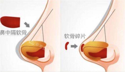 鼻中隔圖片