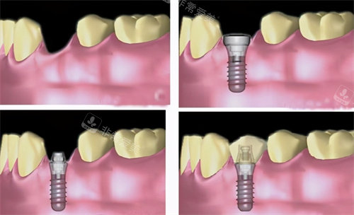 种植牙流程动画图