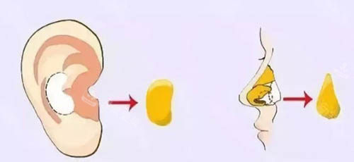 耳软骨隆鼻图 耳软骨隆鼻图