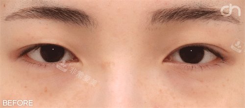 雙眼皮前照片 雙眼皮前照片