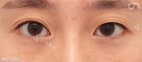 雙眼皮前照片 雙眼皮前照片
