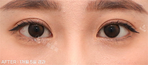 雙眼皮后照片 雙眼皮后照片