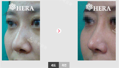 韩国赫拉整形鼻修复前后对比图