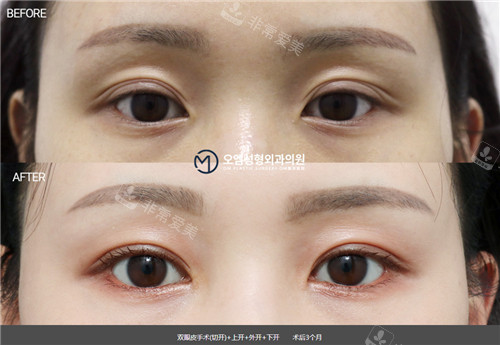 韩国OM整形外科眼部整形对比照