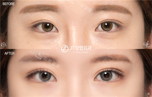 韩国JT整形外科眼部整形对比