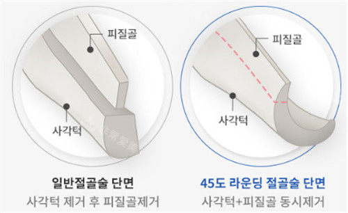 韩国绮林整形截骨方式细节