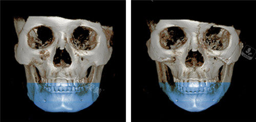 韩国绮林整形下颌手术图