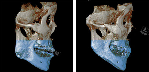 韩国绮林整形下颌角手术侧面照片