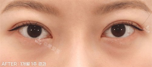 非切開術(shù)矯正眼睛后照片 非切開術(shù)矯正眼睛后照片