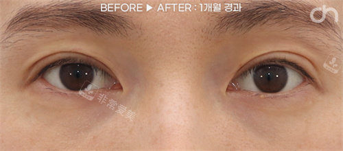 眼部脂肪填充后照片 眼部脂肪填充后照片
