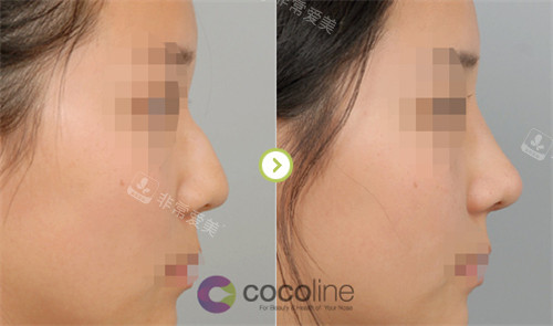 韩国cocoline整形外科箭鼻矫正对比图