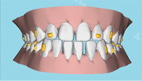牙齿矫正图