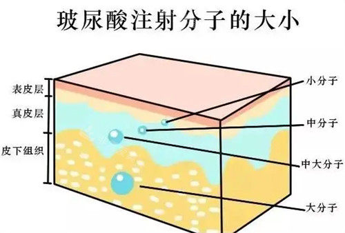 玻尿酸不同成分的注射位置圖解 玻尿酸不同成分的注射位置圖解