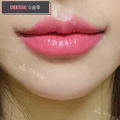 韓國女神口唇整形圖片 韓國女神口唇整形圖片