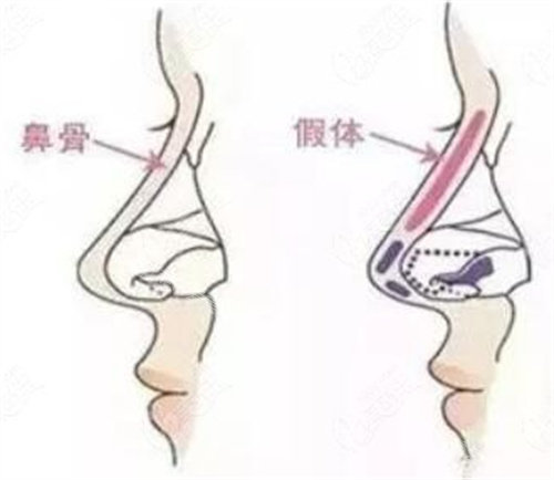 鼻骨和假體圖