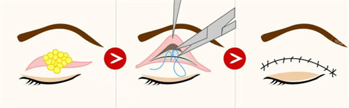 全切双眼皮流程图