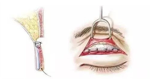 双眼皮缝合动画图