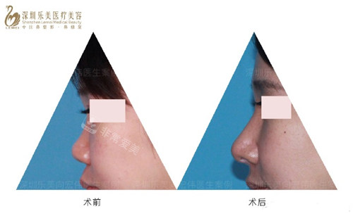 向宏伟隆鼻 向宏伟隆鼻