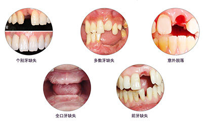 需要進(jìn)行牙齒矯正的各種狀況