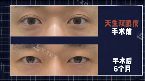 來麗整形外科雙眼皮改單眼皮對比照 來麗整形外科雙眼皮改單眼皮對比照