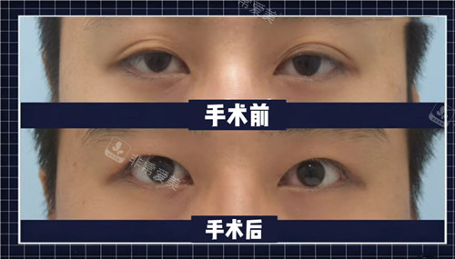 來麗整形外科雙眼皮改單眼皮前后圖 來麗整形外科雙眼皮改單眼皮前后圖