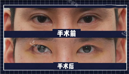 來麗整形外科雙眼皮改單眼皮對比照片 來麗整形外科雙眼皮改單眼皮對比照片