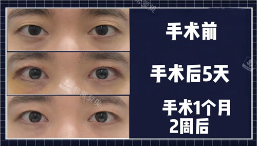 來麗整形外科雙眼皮改單眼皮術(shù)前術(shù)后圖 來麗整形外科雙眼皮改單眼皮術(shù)前術(shù)后圖