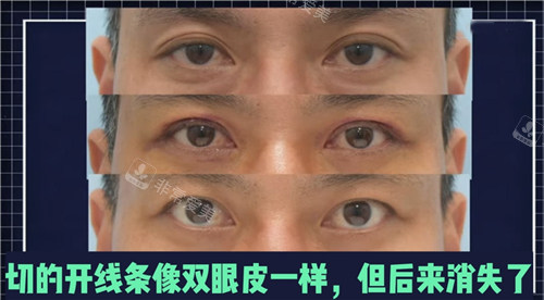 来丽整形外科双眼皮改单眼皮恢复过程图